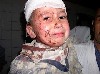 Wounded Iraqi Child